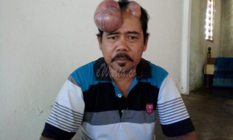 Unang, warga Seluma penderita tumor butuh uluran bantuan dermawan