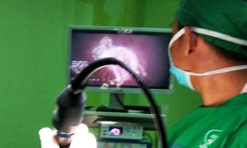 Laparoskopi, Alat Canggih Untuk Operasi Sistem Reproduksi Wanita