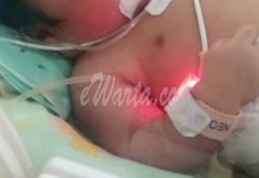 Bayi Penderita Jantung